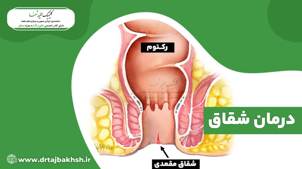 بهترین و موثرترین راه های درمان شقاق