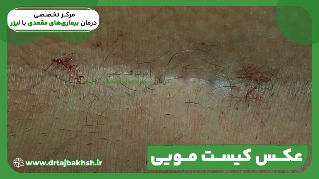 عکس کیست مویی