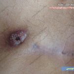 عفونت و چرک کیست مویی مقعد