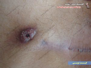 عفونت و چرک کیست مویی مقعد