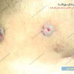 سوراخ های کیست مویی مقعد