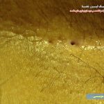 سوراخ های کیست مویی نزدیک مقعد