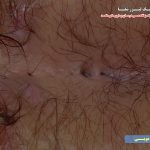 عکس سوراخ های کیست مویی نزدیک مقعد