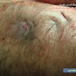 عکس از عفونت کیست مویی