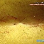 سوراخ کیست مویی