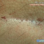 عکس کیست مویی