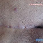 سوراخ کیست مویی نزدیک مقعد