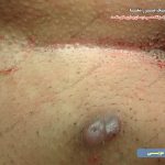عکس ترشح عفونت از سوراخ کیست مویی