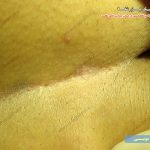 کیست مویی پنهان