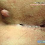 برگشت مویی نزدیک مقعد