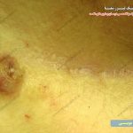 چرک سوراخ کیست مویی مقعد