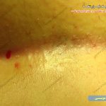 تصویر کیست مویی مقعد