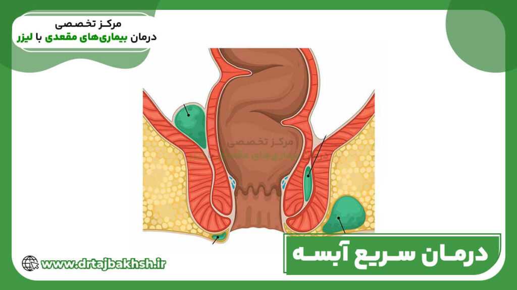 درمان سریع آبسه