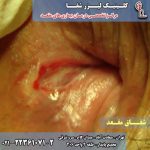 پارگی و زخمت حاصل از شقاق مقعد