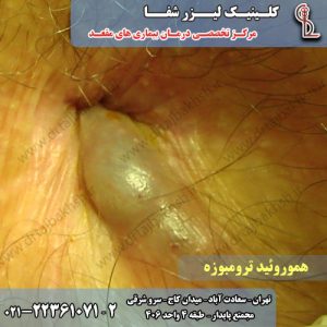 عکس هموروئید ترومبوزه یا همان بواسیر ترومبوزه