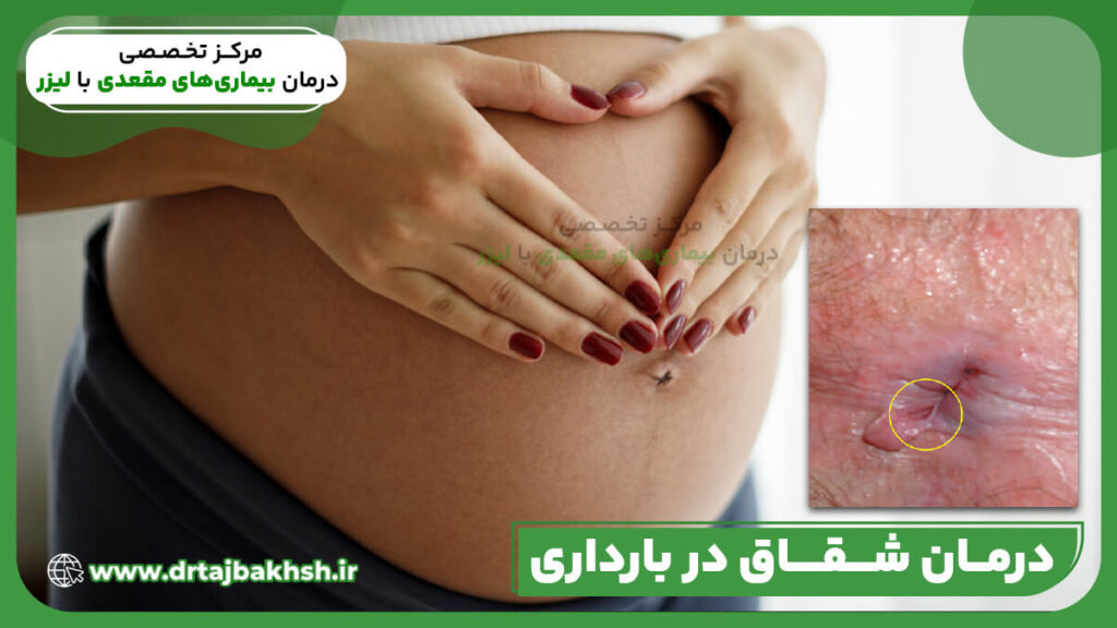 درمان شقاق در بارداری