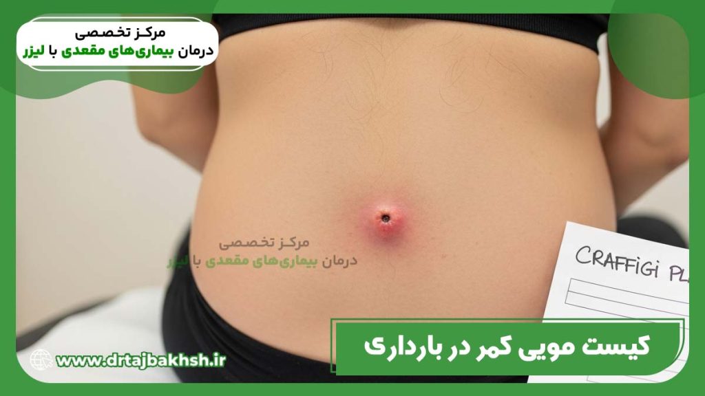 عکس کیست مویی در بارداری