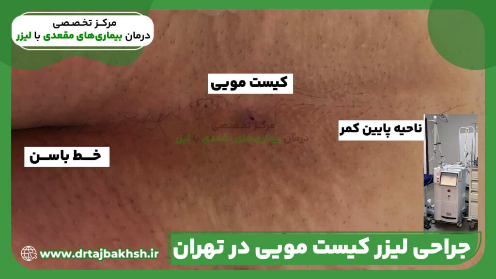 جراحی لیزر کیست مویی در تهران