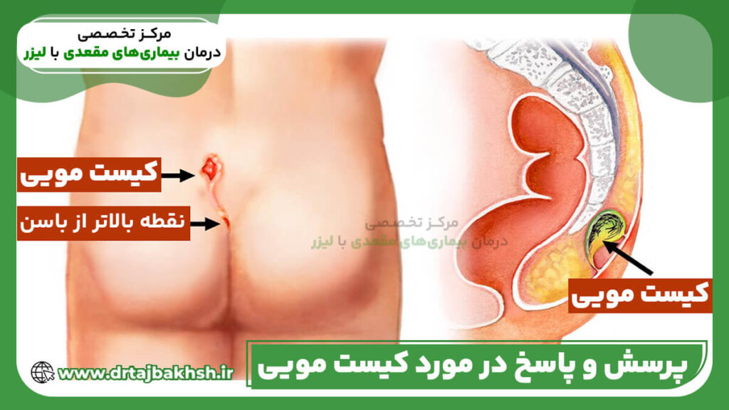 سوالات و پرسش های رایج در مورد بیماری کیست مویی