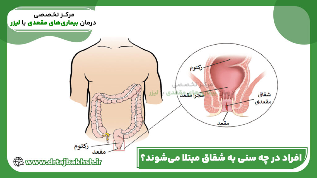 افراد در چه سنی به شقاق مبتلا میشوند؟