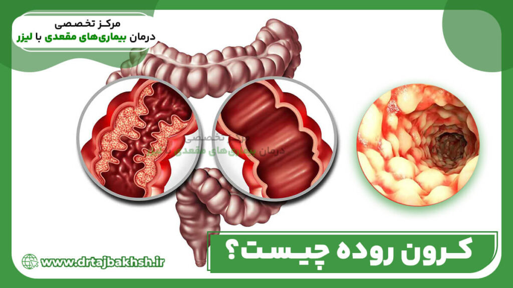 کرون روده چیست؟
