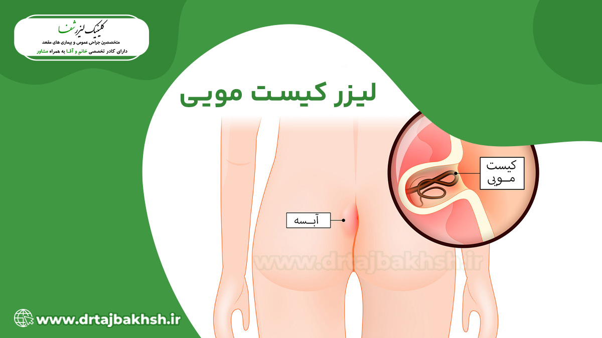 لیزر کیست مویی