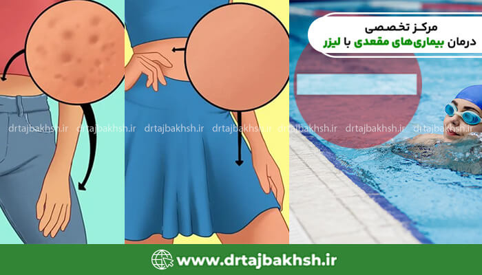 مراقب های لازم بعد از انجام زگیل تناسلی