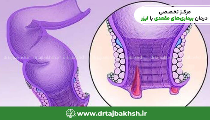 تصویر نشان دهنده لیزر شقاق