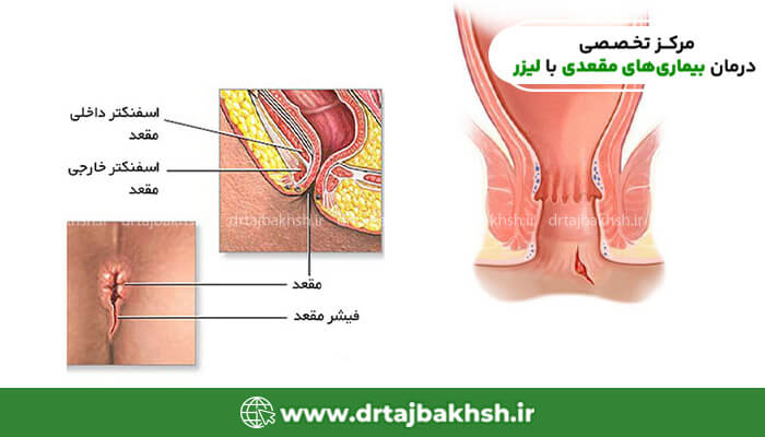 مراحل لیزر شقاق