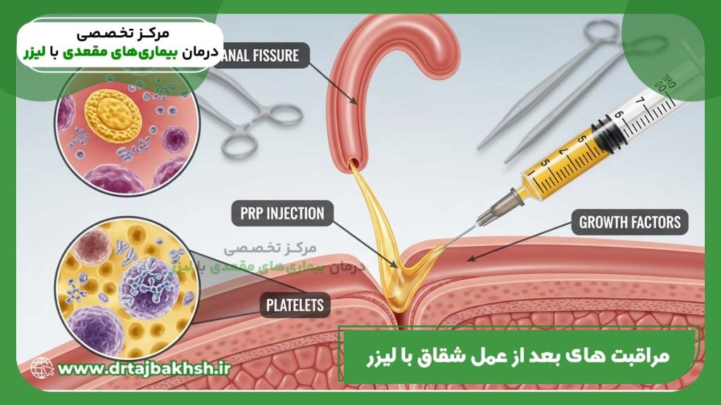 درمان شقاق با PRP