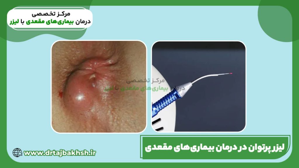 عکس لیزر پرتوان بیماری های مقعدی