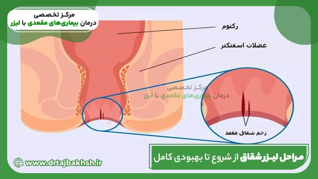 مراحل لیزر شقاق از شروع تا بهبودی
