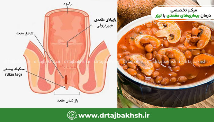 خوردن خوراک لوبیا برای بهبودی شقاق