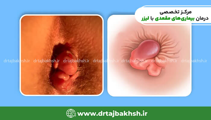 عکس گوشت اضافه مقعدی