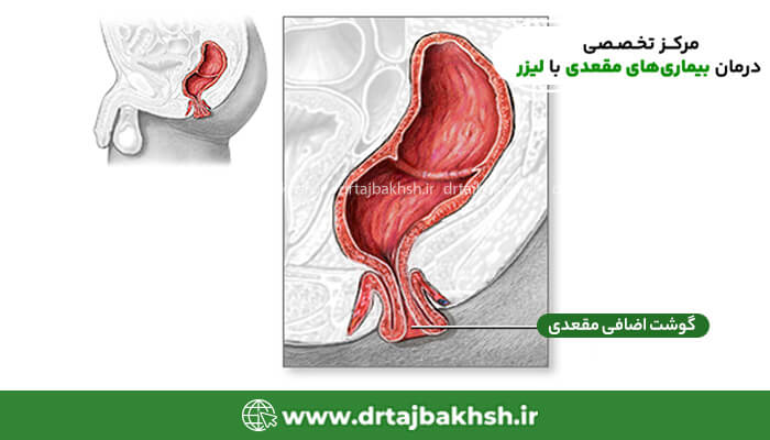 تصویر گوشت اضافه مقعدی