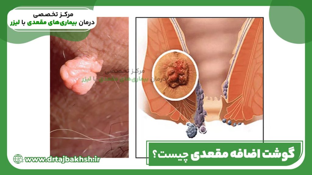 گوشت اضافه مقعدی چیست