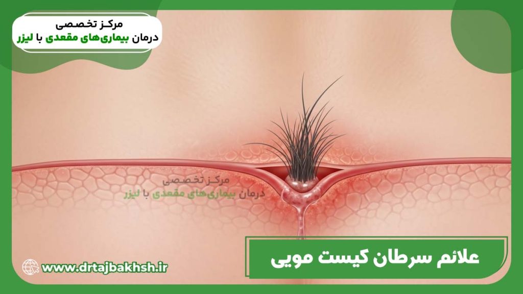 عکس سرطان کیست مویی