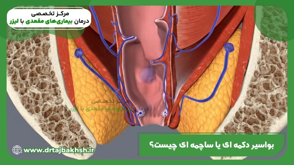تصویر بواسیر دکمه ای