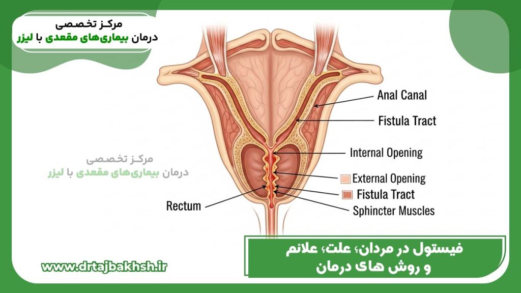 عکس فیستول در مردان