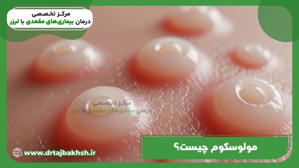 تصویر مولوسکوم چیست