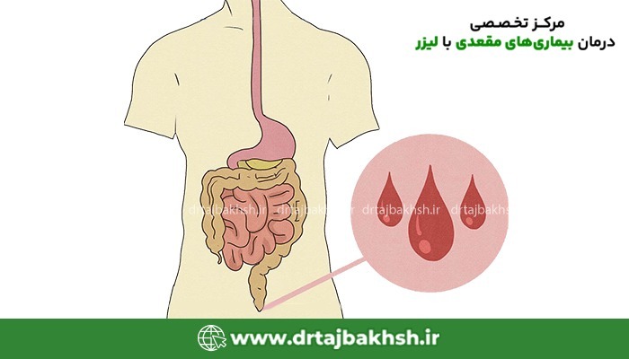 عکس خونریزی مقعدی