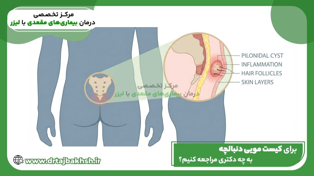 برای کیست مویی دنبالچه به چه دکتری مراجعه کنیم
