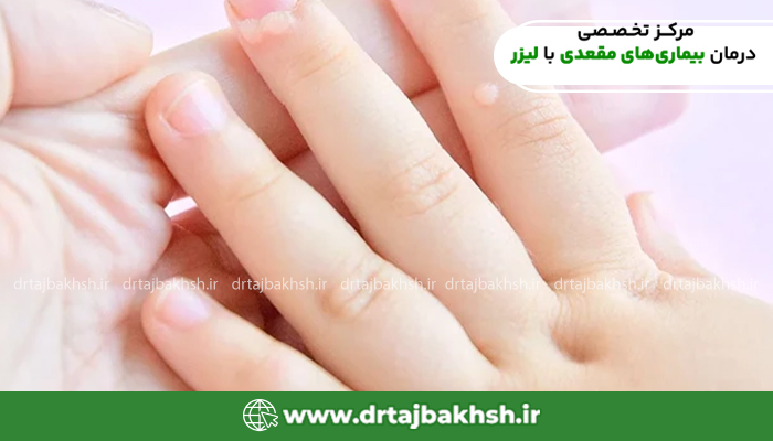 تصویر زگیل
