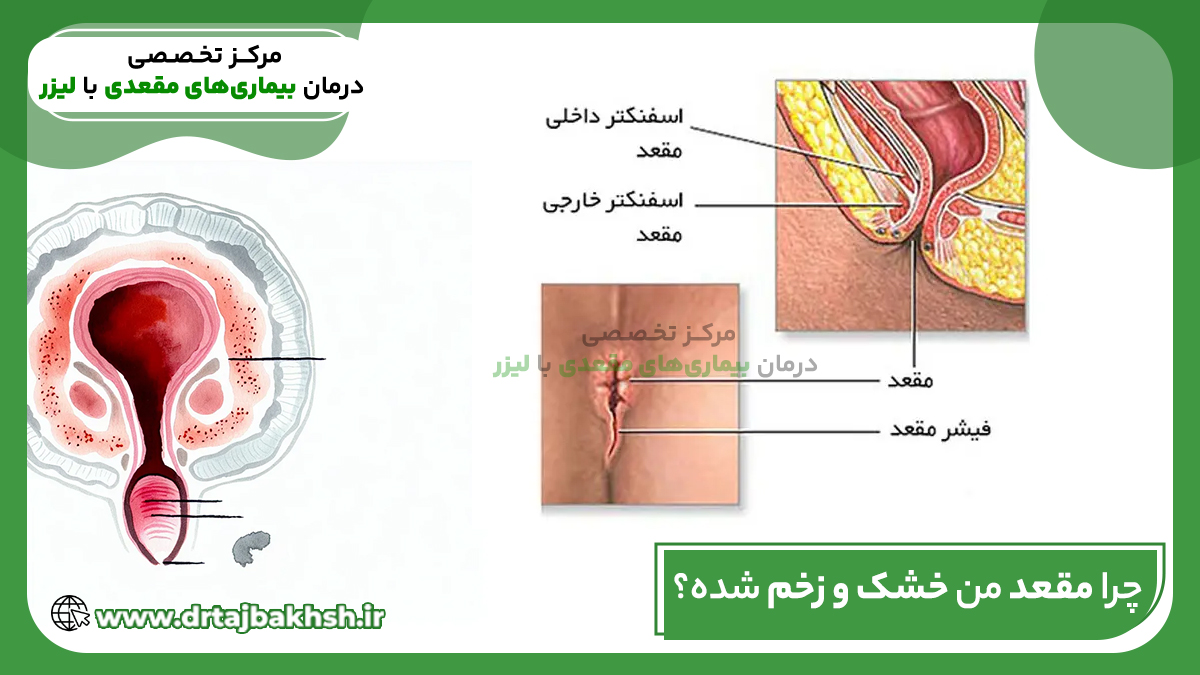 عکس مقعد من خشک و زخم شده؟