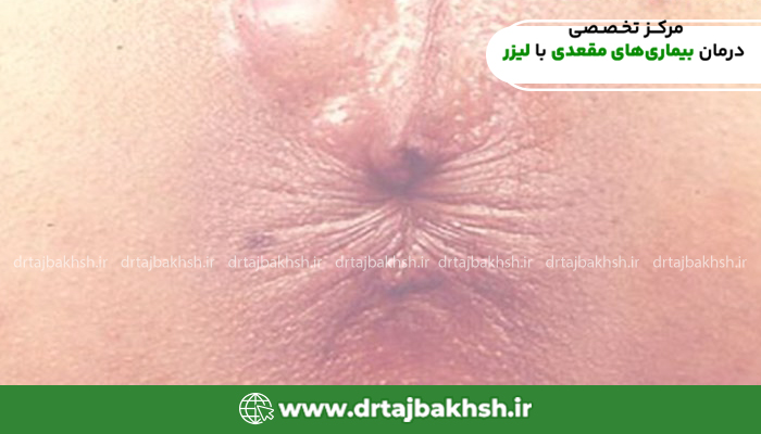 عکس مقعد خشک شده