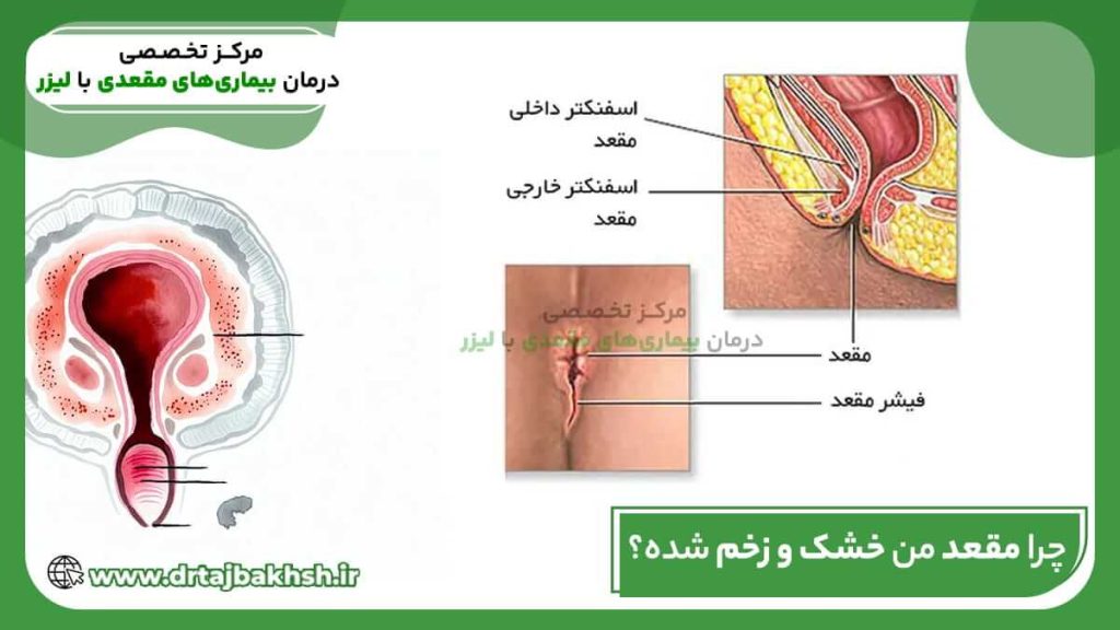 چرا-مقعد-من-خشک-و-زخم-شده؟ درمان