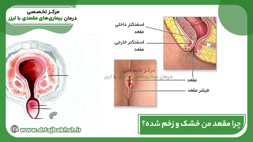 عکس مقعد من خشک و زخم شده؟