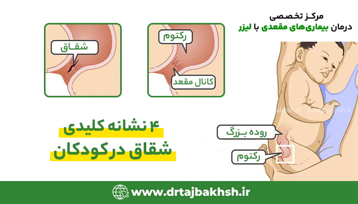 نمای آناتومی شقاق مقعدی در کانال مقعد و رکتوم کودکان
