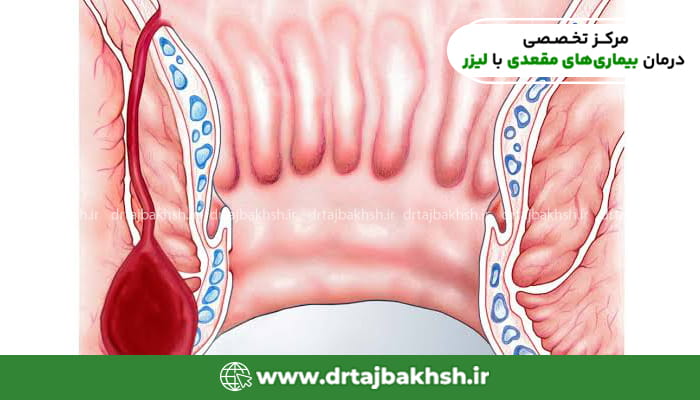 تصویر شماتیک آناتومی کانال مقعد و بیماریهای نشیمنگاهی برای درک بهتر درمان با لیزر