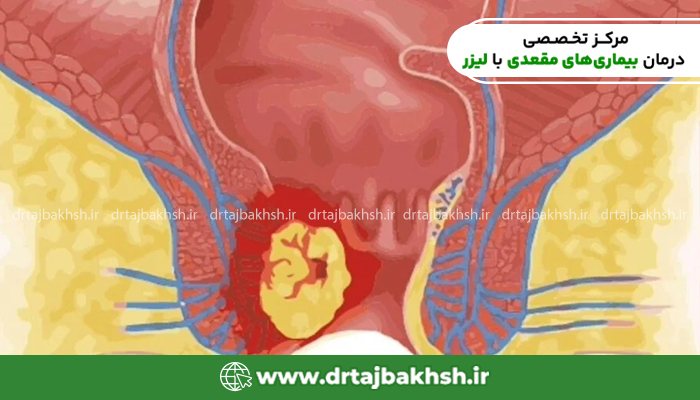 علائم هشداردهنده و پیشرفته تر سرطان مقعد